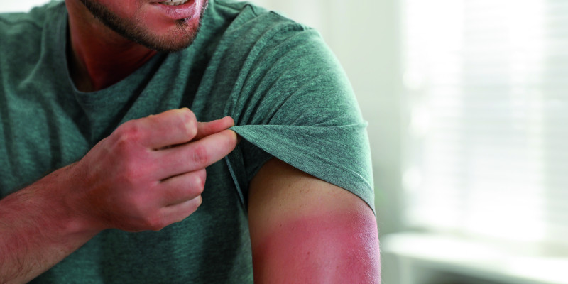 The picture shows a man’s upper arm in focus. The man is lifting the sleeve of his T-shirt with two fingers. In contrast with the skin previously covered by the T-shirt, the part of the skin that has been exposed to sunlight looks very red.