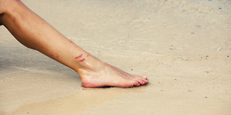 The picture shows an outstretched foot on a sandy beach. There are two abrasions visible above the ankle.