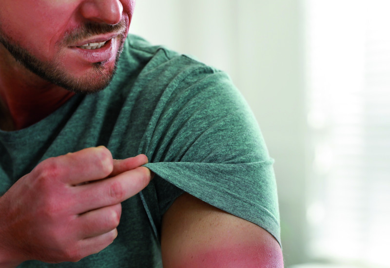 The picture shows a man’s upper arm in focus. The man is lifting the sleeve of his T-shirt with two fingers. In contrast with the skin previously covered by the T-shirt, the part of the skin that has been exposed to sunlight looks very red.