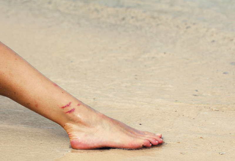 The picture shows an outstretched foot on a sandy beach. There are two abrasions visible above the ankle.